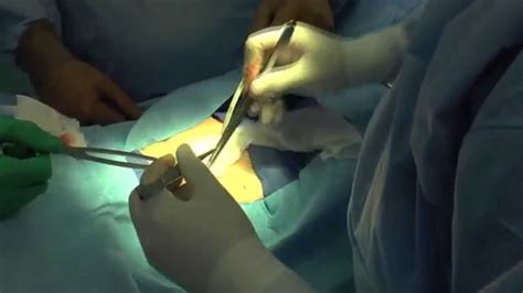 inguinal hernia repair surgery video